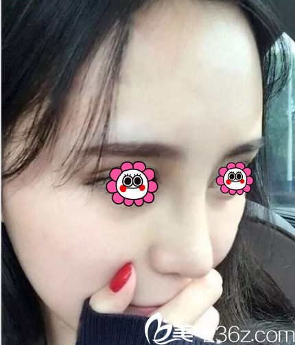 韓國ROCOCO金相虎隆鼻案例 韓國ROCOCO金相虎隆鼻案例