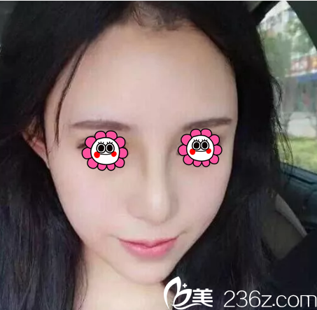 金相虎鼻綜合隆鼻案例1月效果 金相虎鼻綜合隆鼻案例1月效果