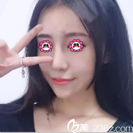 分享我在韓國ROCOCO整形醫(yī)院找金相虎做鼻綜合隆鼻2月真實效果