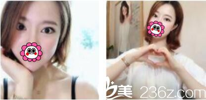 一個月前去韓國姜元景做了雙眼皮，沒想到姜元景技術(shù)真的不是吹的恢復(fù)的特別自然