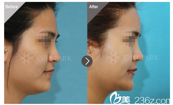 額頭脂肪移植，下巴溶脂.png