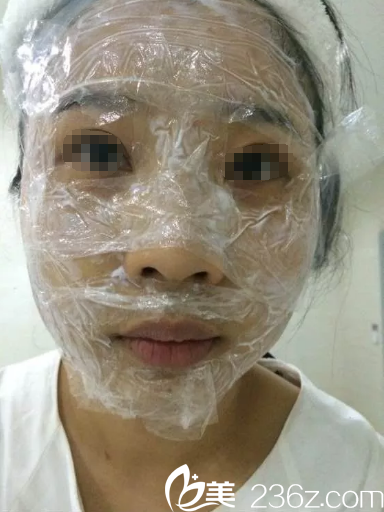 皮秒祛斑術(shù)前敷麻藥過程中 皮秒祛斑術(shù)前敷麻藥過程中