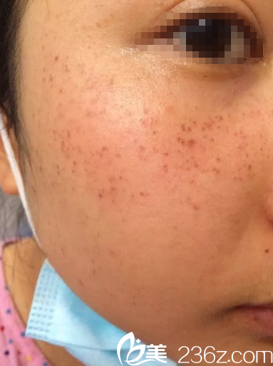 剛做完皮秒祛斑面部有些發(fā)紅 剛做完皮秒祛斑面部有些發(fā)紅