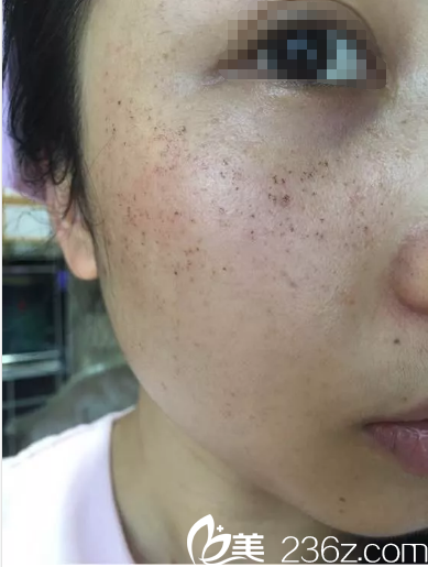 皮秒祛斑術(shù)后三天開始掉痂 皮秒祛斑術(shù)后三天開始掉痂