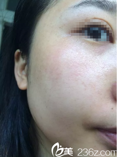 有沒有想到揚州艾菲斯祛斑的?先來看我找王愛梅做的蜂巢皮秒術后效果一次就很明顯