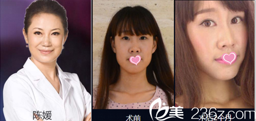 北京美萊陳媛眼綜合瘦臉<span style= 北京美萊陳媛眼綜合瘦臉<span style=