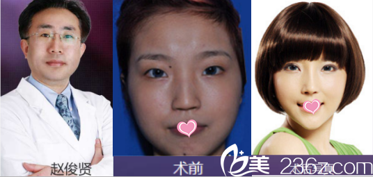 北京美萊趙峻賢雙眼皮<span style= 北京美萊趙峻賢雙眼皮<span style=