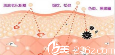 光子嫩膚的方法 光子嫩膚的方法