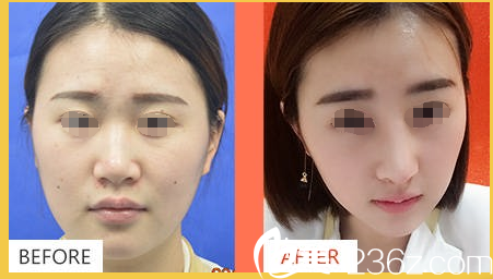 揚州美貝爾仿真隆鼻案例