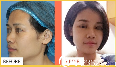 自體脂肪面部填充術(shù)前術(shù)后對比