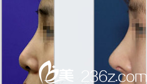 韓國Ree&Ahn Clinic醫(yī)院隆鼻案例 韓國Ree&Ahn Clinic醫(yī)院隆鼻案例