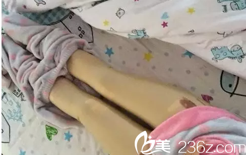 Ree&Ahn Clinic腿部吸脂第2天樣子