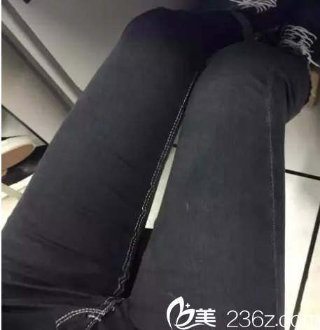 Ree&Ahn Clinic安俊泰腿部吸脂案例