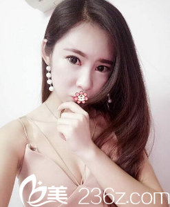 貴陽美萊雙眼皮術(shù)后一個月 貴陽美萊雙眼皮術(shù)后一個月