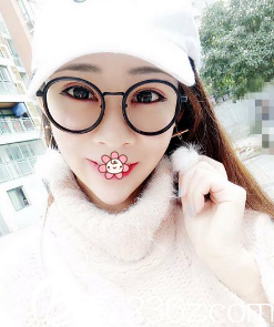 羅曼雙眼皮術(shù)后14天 羅曼雙眼皮術(shù)后14天