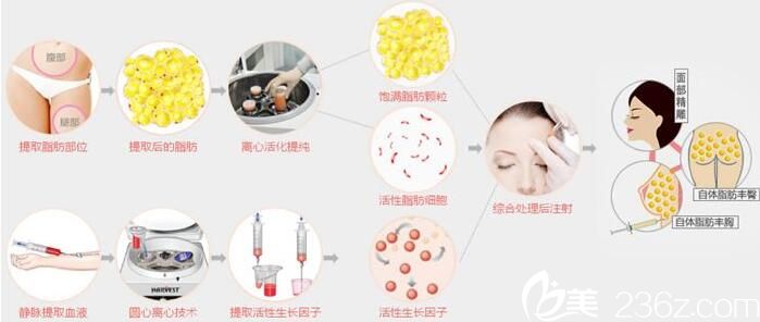 韓國(guó)金世永整形外科自體脂肪移植圖 韓國(guó)金世永整形外科自體脂肪移植圖