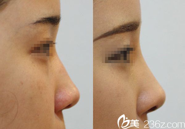 韓國珍愛整形醫(yī)院隆鼻真人案例分享 韓國珍愛整形醫(yī)院隆鼻真人案例分享