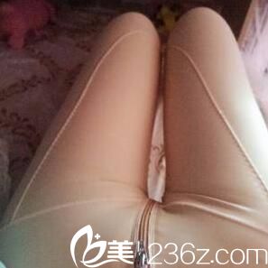 吸脂瘦大腿術(shù)后天 吸脂瘦大腿術(shù)后天