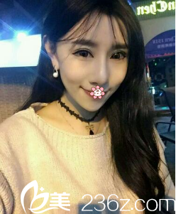 朱曉東自體脂肪全臉填充術(shù)后12天 朱曉東自體脂肪全臉填充術(shù)后12天