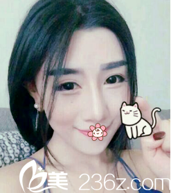 貴陽美貝爾自體脂肪全臉填充術(shù)后19天 貴陽美貝爾自體脂肪全臉填充術(shù)后19天