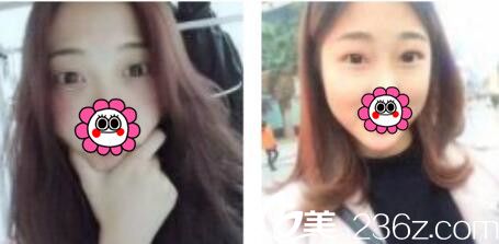 韓國金世永整形外科金世永雙眼皮真人案例術前照 韓國金世永整形外科金世永雙眼皮真人案例術前照