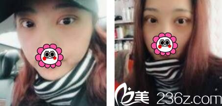 韓國金世永整形外科金世永雙眼皮真人案例術后第三天 韓國金世永整形外科金世永雙眼皮真人案例術后第三天