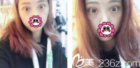 韓國金世永整形外科金世永雙眼皮真人案例術后第七天 韓國金世永整形外科金世永雙眼皮真人案例術后第七天