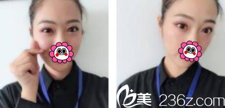 韓國金世永整形外科金世永雙眼皮真人案例術后二十一天 韓國金世永整形外科金世永雙眼皮真人案例術后二十一天