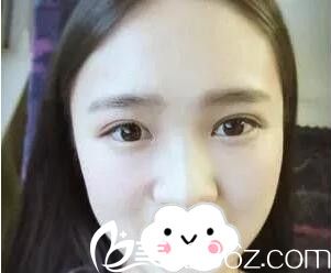 看我找長沙希美整形醫(yī)院肖陽做的全切雙眼皮+開內(nèi)眼角術(shù)后2個月效果怎么樣