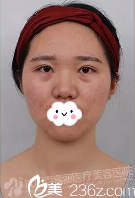 在百嘉麗做微針祛痘術(shù)前照 在百嘉麗做微針祛痘術(shù)前照