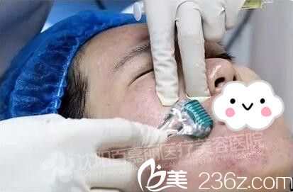百嘉麗微針祛痘術(shù)過程中 百嘉麗微針祛痘術(shù)過程中