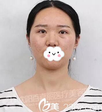 在百嘉麗做微針祛痘術(shù)后3天 在百嘉麗做微針祛痘術(shù)后3天