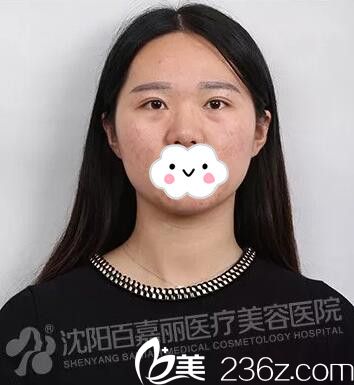 在沈陽百嘉麗做微針祛痘術(shù)后半個(gè)月 在沈陽百嘉麗做微針祛痘術(shù)后半個(gè)月