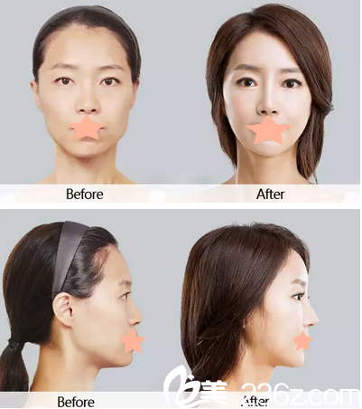 李信奎鼻部整形真人案例 李信奎鼻部整形真人案例