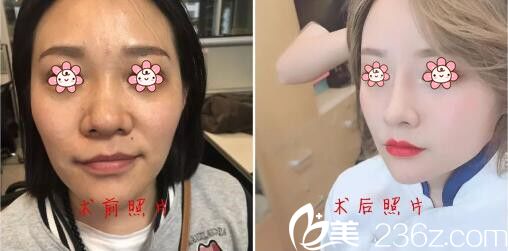 韓國PRIME整形外科金永燦鼻修復案例 韓國PRIME整形外科金永燦鼻修復案例