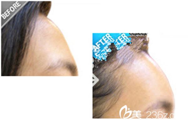 崔錫勛院長自體脂肪豐額頭案例 崔錫勛院長自體脂肪豐額頭案例