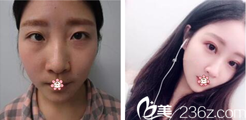 金永燦院長雙眼皮修復(fù)案例 金永燦院長雙眼皮修復(fù)案例