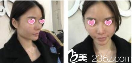 韓國金在中整形外科金在中假體隆鼻真人案例術前照 韓國金在中整形外科金在中假體隆鼻真人案例術前照