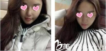 韓國金在中整形外科金在中假體隆鼻真人案例術后第七天 韓國金在中整形外科金在中假體隆鼻真人案例術后第七天