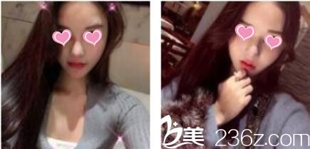 韓國金在中整形外科金在中假體隆鼻真人案例術后一個月 韓國金在中整形外科金在中假體隆鼻真人案例術后一個月