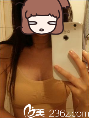 術后第15天 術后第15天