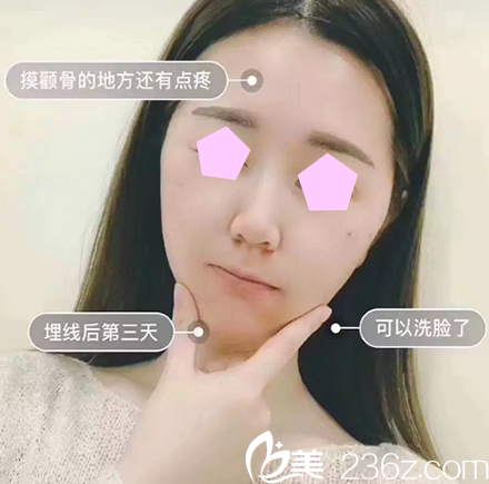 我在太原華美做臉部線雕術(shù)后第3天照片 我在太原華美做臉部線雕術(shù)后第3天照片