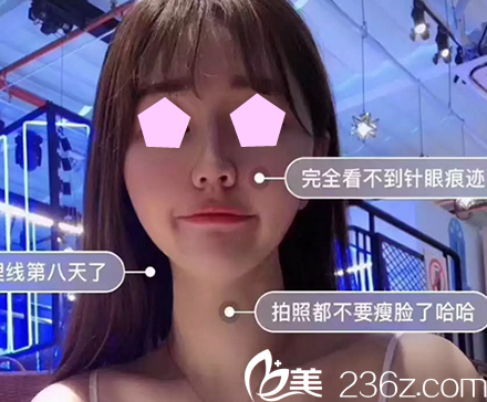 對比了太原時(shí)光整形和華美整形后，我選擇了在價(jià)格實(shí)惠的華美整形做了面部線雕提升