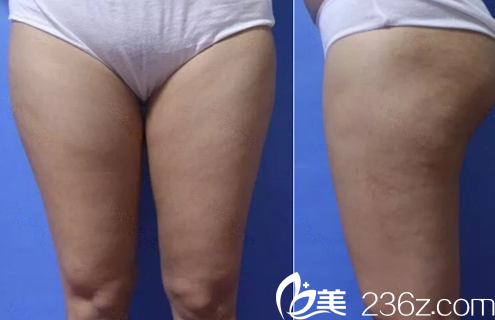 我在聊城韓美整形美容醫(yī)院做腿部吸脂前照片 我在聊城韓美整形美容醫(yī)院做腿部吸脂前照片
