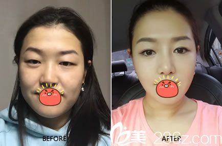 紹興維美整形康樂雙眼皮案例 紹興維美整形康樂雙眼皮案例