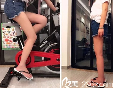 說說我在聊城韓美整形花980元做的水動力大腿吸脂真實經(jīng)歷