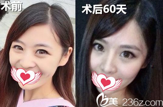 福華整形鼻綜合前后對比照 福華整形鼻綜合前后對比照