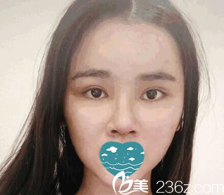 在三亞紅妝尚做自體軟骨隆鼻一周拆線