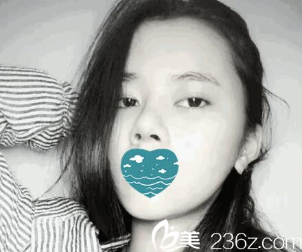 自體軟骨隆鼻第九天照