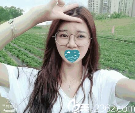 在紅妝尚做自體軟骨隆鼻半個月照